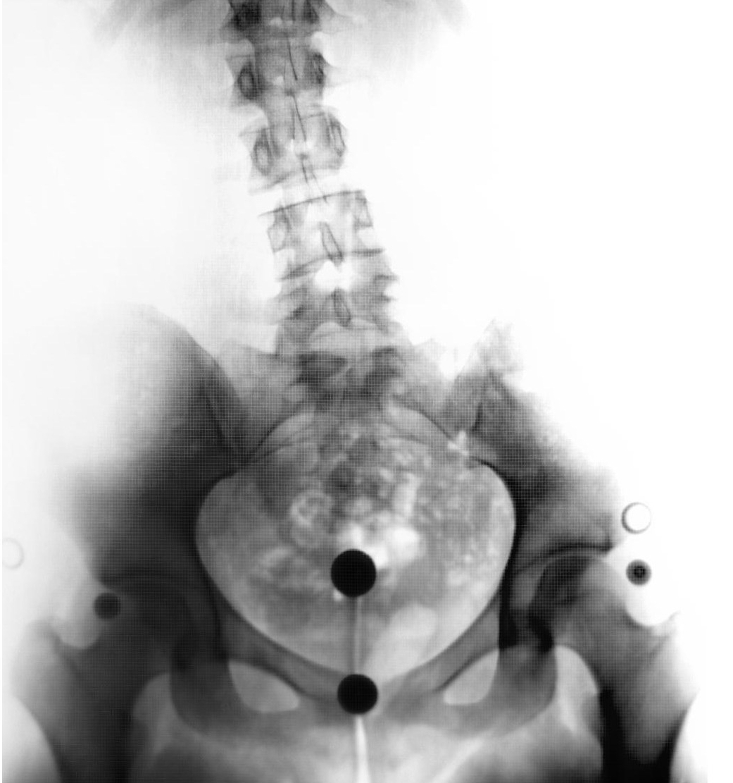 X Ray provided by author, bone black on a white background, pelvis and spine make visible shadows. 